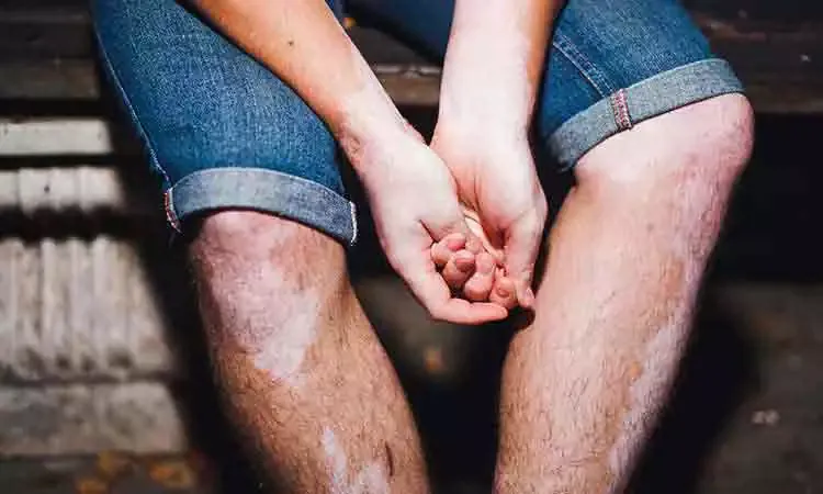 Is it safe to get a Tattoo if you have Vitiligo?